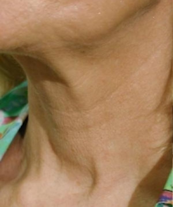 Neck Rejuvenation Before & After Gallery - Patient 5930121 - Image 1