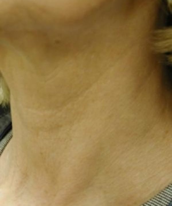 Neck Rejuvenation Before & After Gallery - Patient 5930121 - Image 2