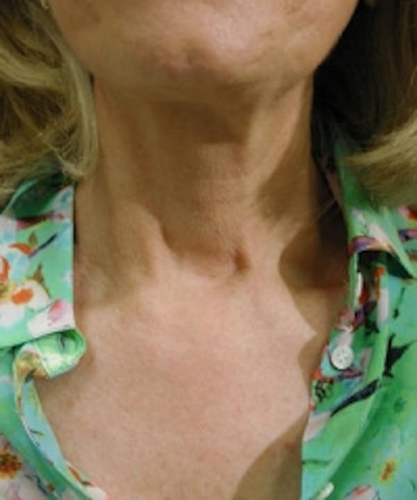 Neck Rejuvenation Before & After Gallery - Patient 5930122 - Image 1