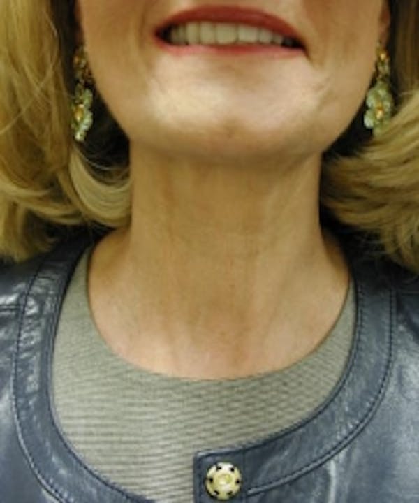 Neck Rejuvenation Before & After Gallery - Patient 5930122 - Image 2