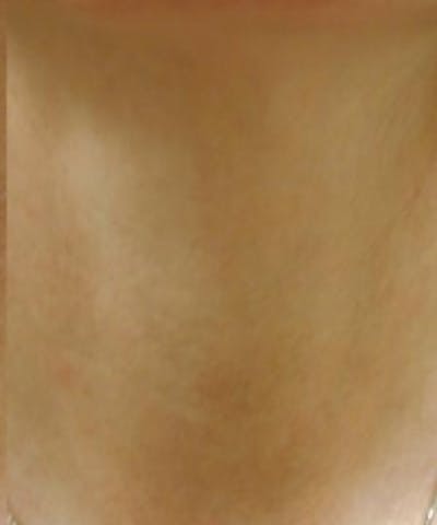 Neck Rejuvenation Before & After Gallery - Patient 5930124 - Image 2