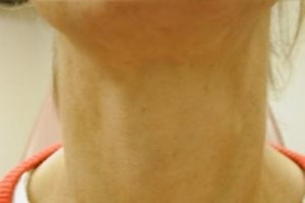 Neck Rejuvenation Before & After Gallery - Patient 5930125 - Image 2