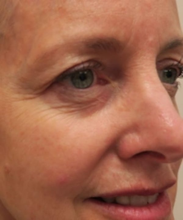 Eyelid Rejuvenation Before & After Gallery - Patient 5930148 - Image 1