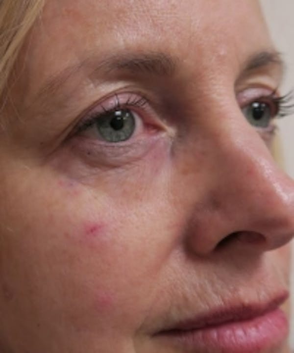 Eyelid Rejuvenation Before & After Gallery - Patient 5930148 - Image 2