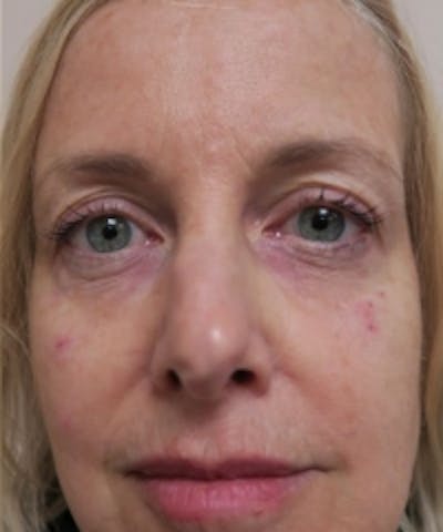 Eyelid Rejuvenation Before & After Gallery - Patient 5930151 - Image 2