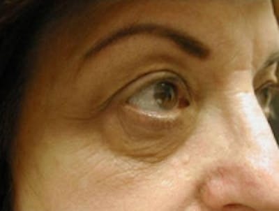 Eyelid Rejuvenation Before & After Gallery - Patient 5930162 - Image 1