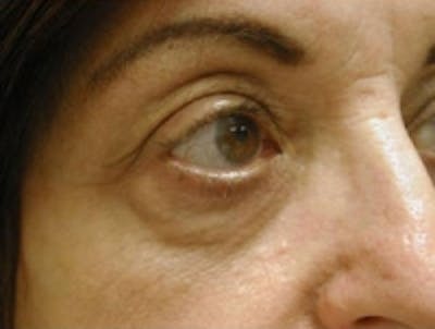 Eyelid Rejuvenation Before & After Gallery - Patient 5930162 - Image 2