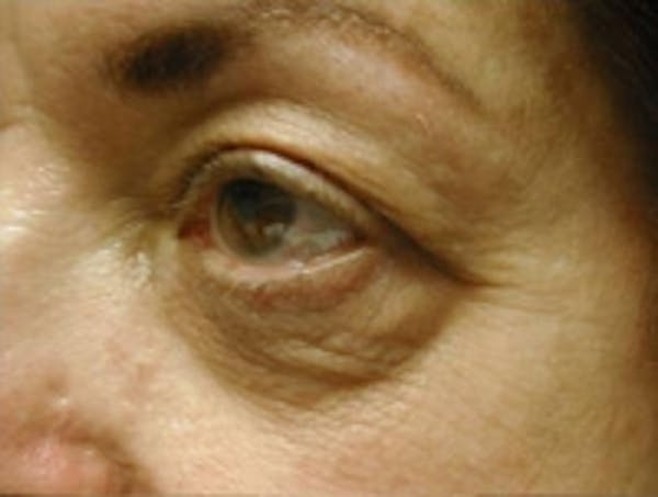 Eyelid Rejuvenation Before & After Gallery - Patient 5930162 - Image 3