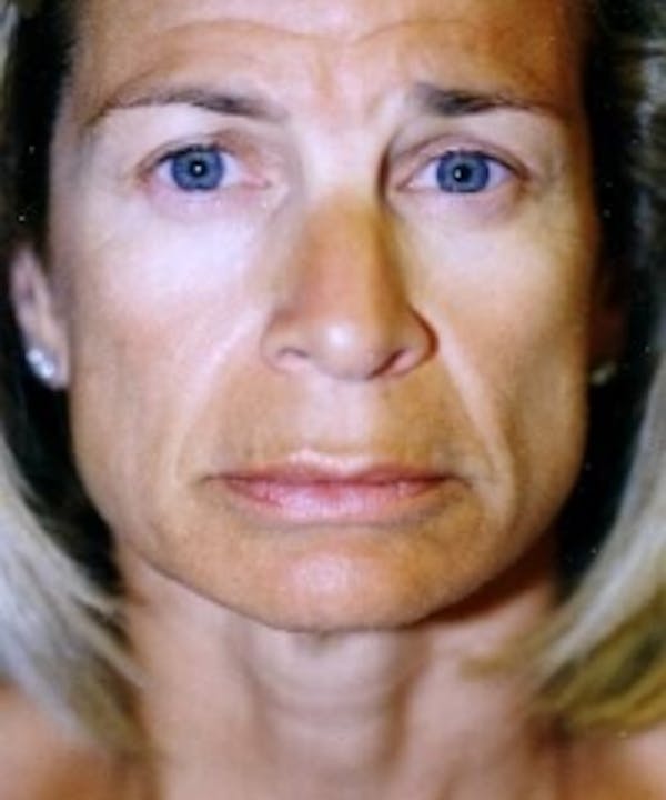 Botox Before & After Gallery - Patient 5930163 - Image 1