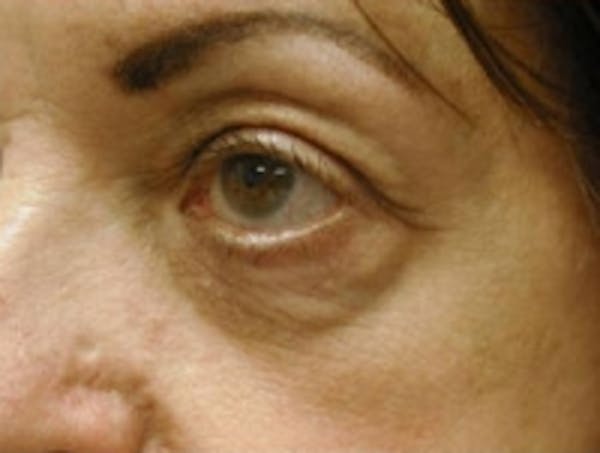 Eyelid Rejuvenation Before & After Gallery - Patient 5930162 - Image 4