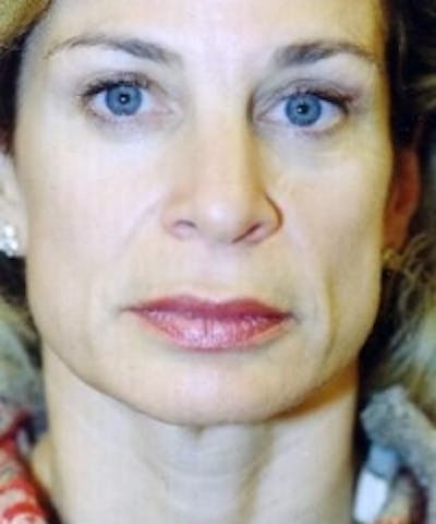 Botox Before & After Gallery - Patient 5930163 - Image 2
