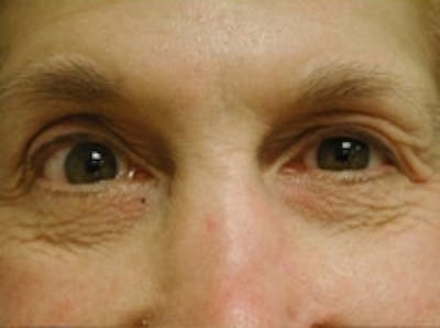 Eyelid Rejuvenation Before & After Gallery - Patient 5930167 - Image 1