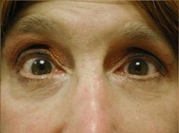 Eyelid Rejuvenation Before & After Gallery - Patient 5930167 - Image 2