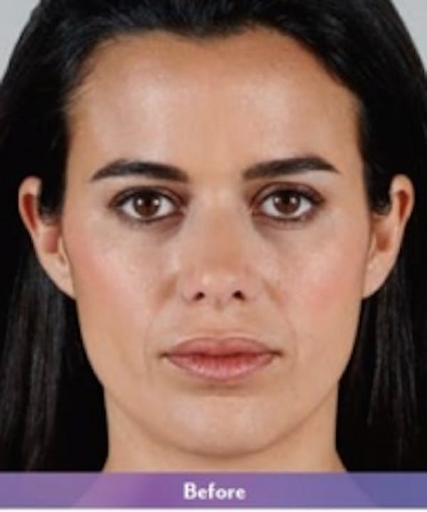 Fillers Before & After Gallery - Patient 5930166 - Image 1