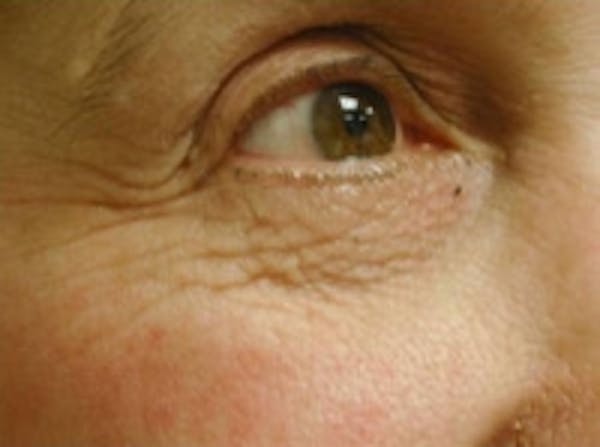Eyelid Rejuvenation Before & After Gallery - Patient 5930167 - Image 3