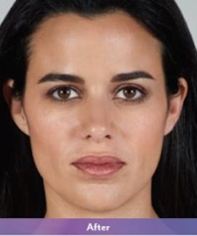 Fillers Before & After Gallery - Patient 5930166 - Image 2