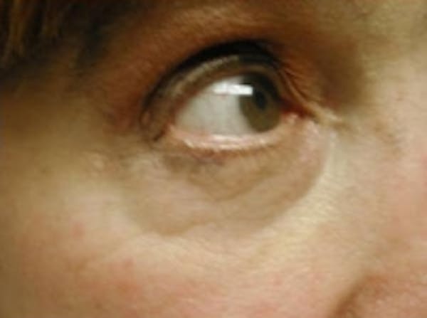 Eyelid Rejuvenation Before & After Gallery - Patient 5930167 - Image 4