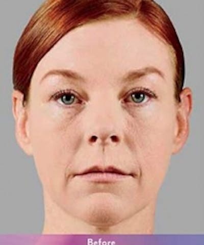 Fillers Before & After Gallery - Patient 5930168 - Image 1