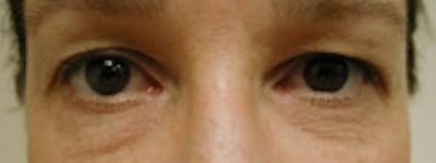 Eyelid Rejuvenation Before & After Gallery - Patient 5930169 - Image 1