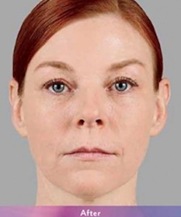 Fillers Before & After Gallery - Patient 5930168 - Image 2