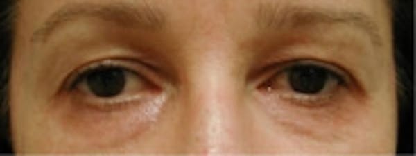Eyelid Rejuvenation Before & After Gallery - Patient 5930169 - Image 2