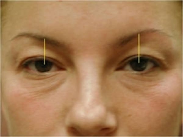 Eyelid Rejuvenation Before & After Gallery - Patient 5930170 - Image 1
