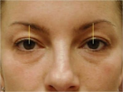 Eyelid Rejuvenation Before & After Gallery - Patient 5930170 - Image 2