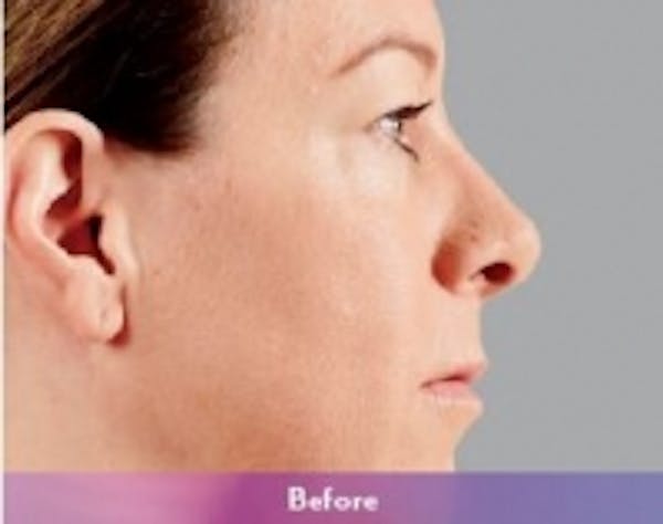 Fillers Before & After Gallery - Patient 5930171 - Image 3