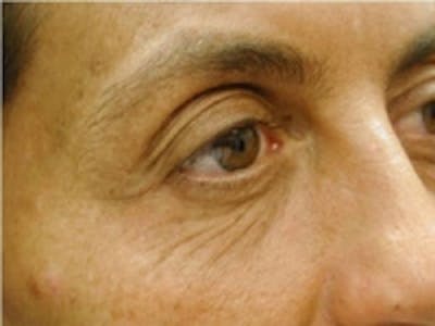 Eyelid Rejuvenation Before & After Gallery - Patient 5930173 - Image 1