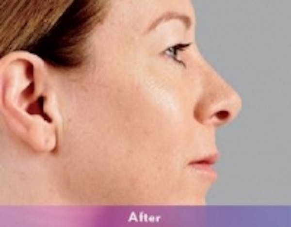 Fillers Before & After Gallery - Patient 5930171 - Image 4