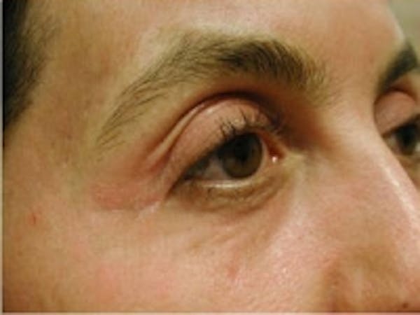 Eyelid Rejuvenation Before & After Gallery - Patient 5930173 - Image 2