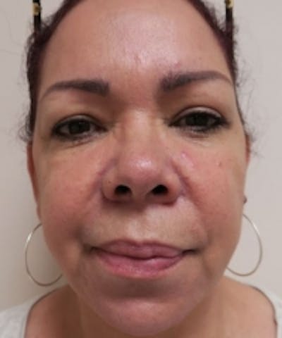 Fillers Before & After Gallery - Patient 5930172 - Image 1
