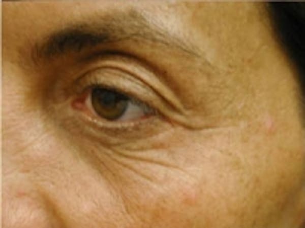 Eyelid Rejuvenation Before & After Gallery - Patient 5930173 - Image 3
