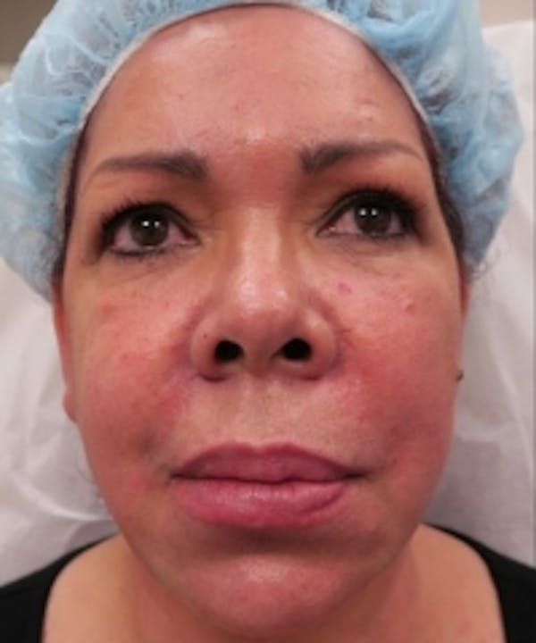 Fillers Before & After Gallery - Patient 5930172 - Image 2