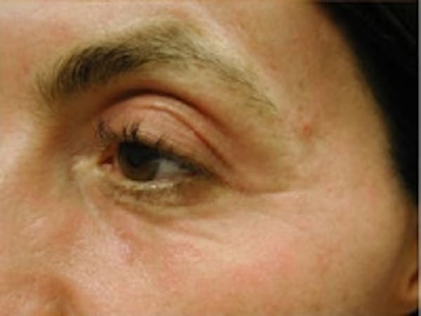 Eyelid Rejuvenation Before & After Gallery - Patient 5930173 - Image 4