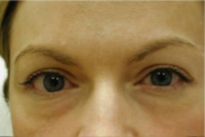 Eyelid Rejuvenation Before & After Gallery - Patient 5930178 - Image 1
