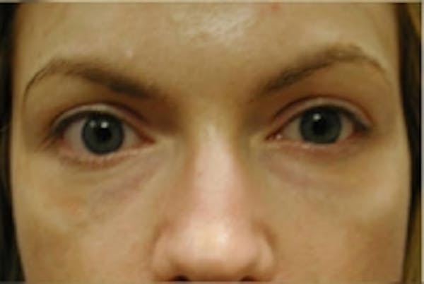 Eyelid Rejuvenation Before & After Gallery - Patient 5930178 - Image 2