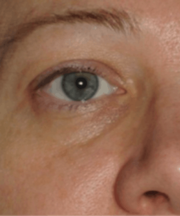 Eyelid Rejuvenation Before & After Gallery - Patient 5930179 - Image 1