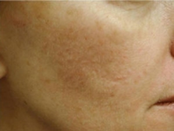 Acne scar treatment results in NYC at JUVA Skin & Laser Center