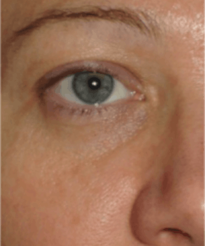 Eyelid Rejuvenation Before & After Gallery - Patient 5930179 - Image 2