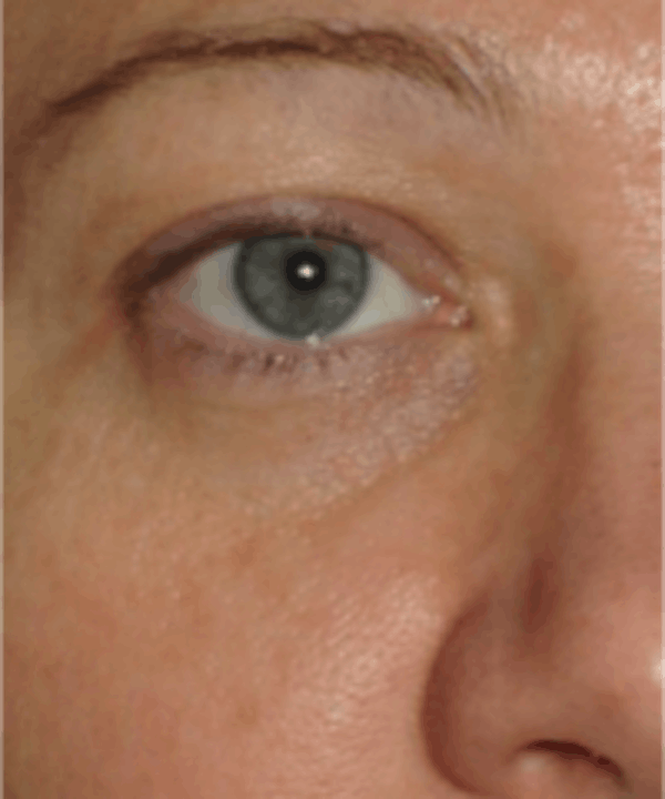 Eyelid Rejuvenation Before & After Gallery - Patient 5930179 - Image 2