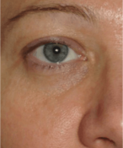 Eyelid Rejuvenation Gallery - Patient 5930179 - Image 2