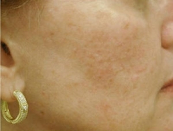 Acne scar treatment results in NYC at JUVA Skin & Laser Center