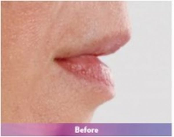 Fillers Before & After Gallery - Patient 5930181 - Image 3