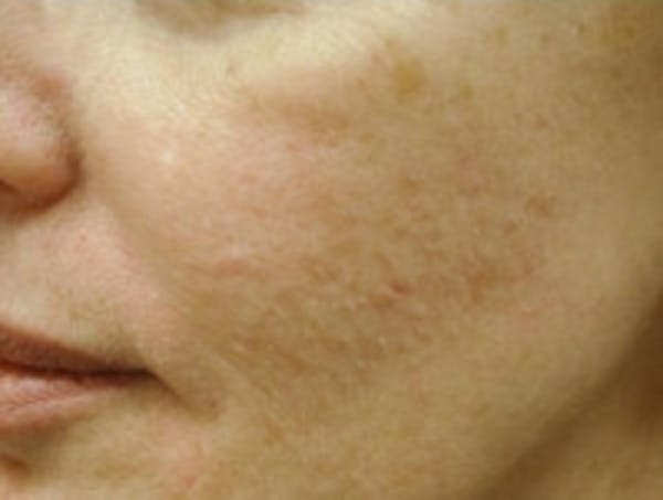 Acne Scarring Before & After Gallery - Patient 5930182 - Image 3