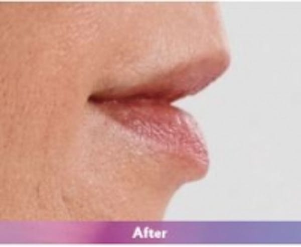 Fillers Before & After Gallery - Patient 5930181 - Image 4