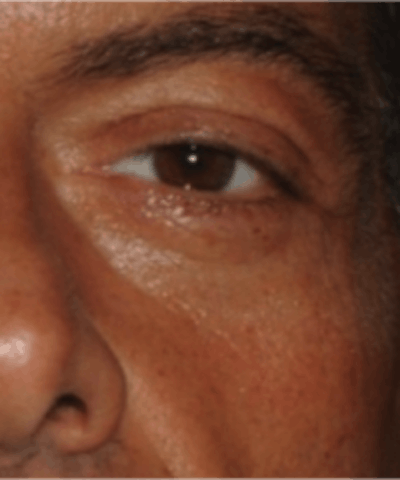 Eyelid Rejuvenation Before & After Gallery - Patient 5930183 - Image 1