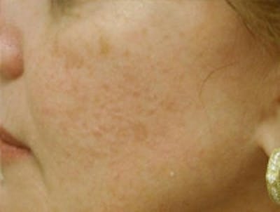 Acne Scarring Before & After Gallery - Patient 5930182 - Image 4