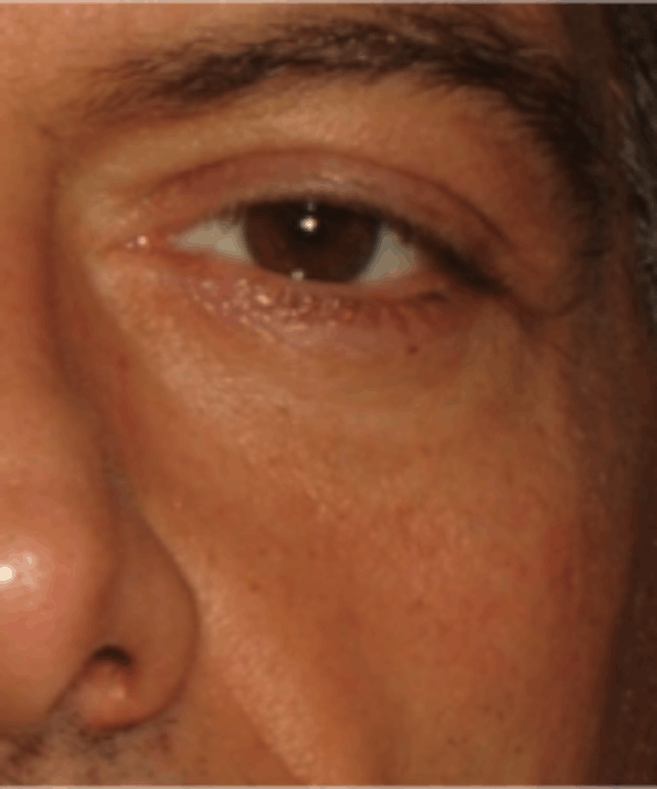 Eyelid Rejuvenation Before & After Gallery - Patient 5930183 - Image 2