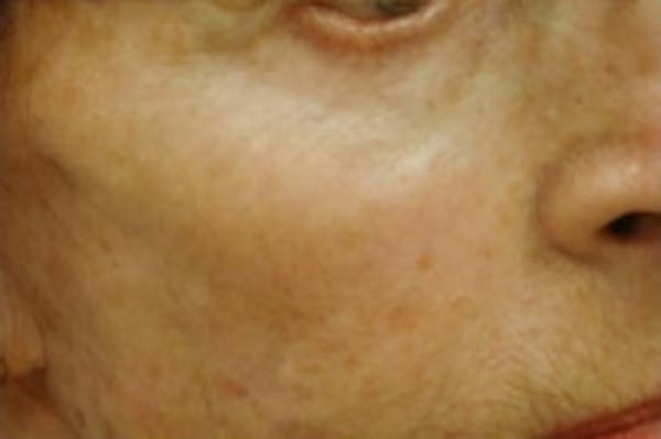 Fillers Before & After Gallery - Patient 5930184 - Image 2